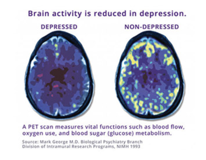 Depression Medication Alternative